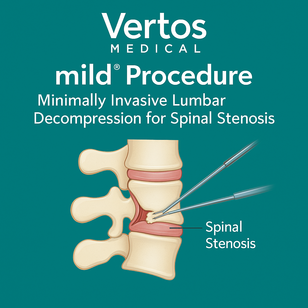 Medical illustration showing minimally invasive lumbar decompression using surgical tools on the spine for spinal stenosis relief.